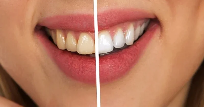 Laser vs. LED Teeth Whitening: A Technological Comparison